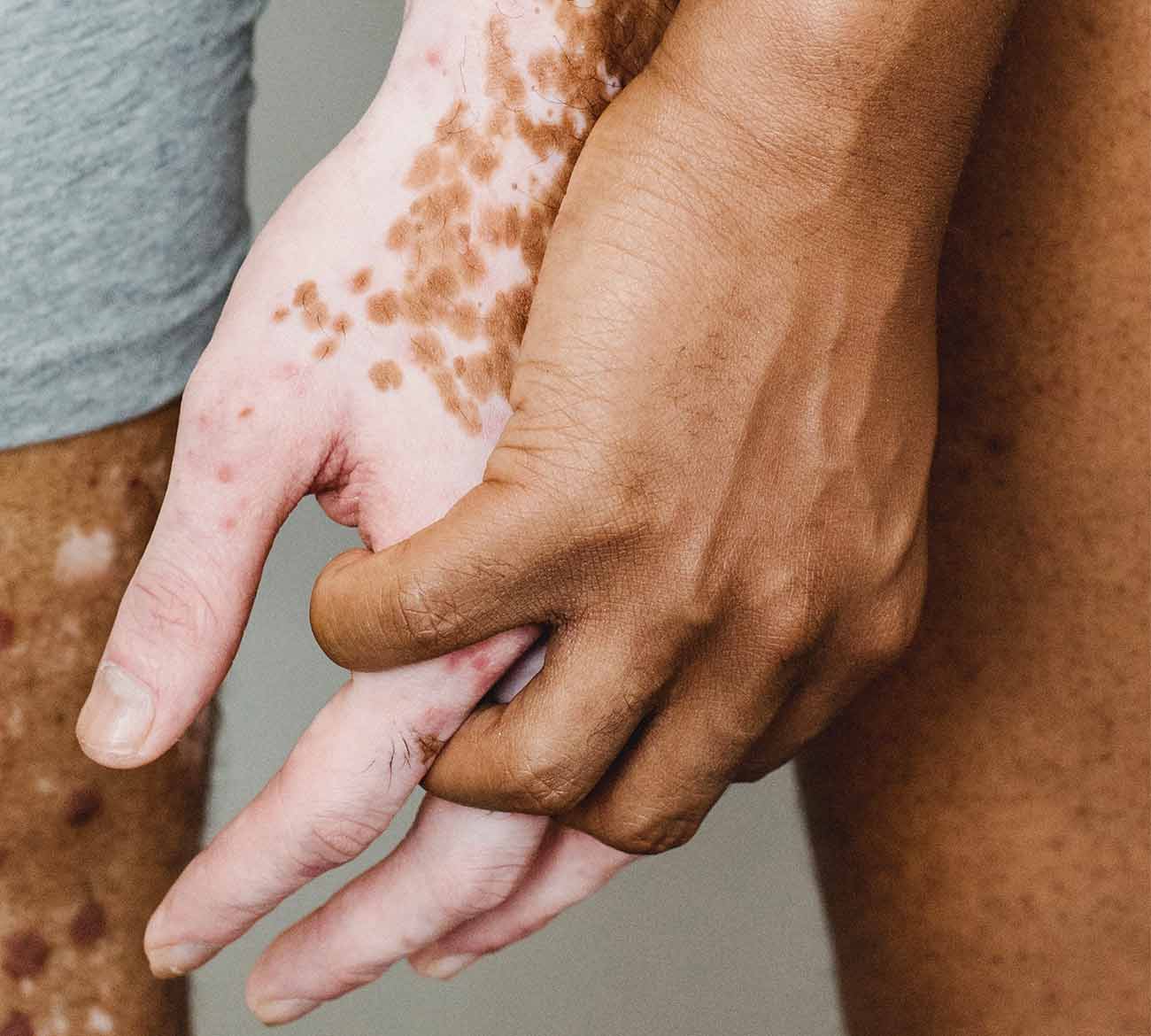 Burnt Hand